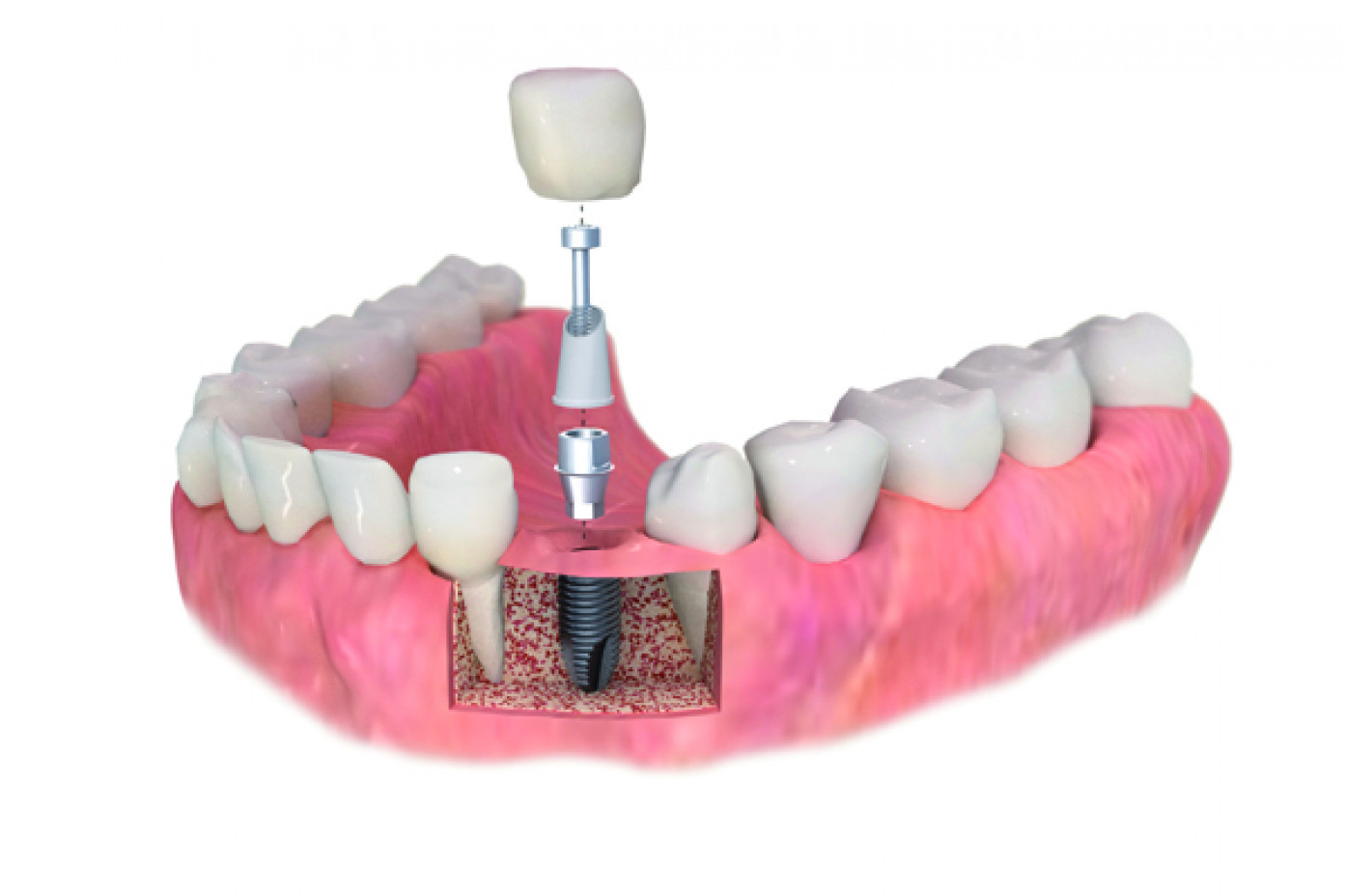 Implantes y Prótesis dentales Dr Smile
