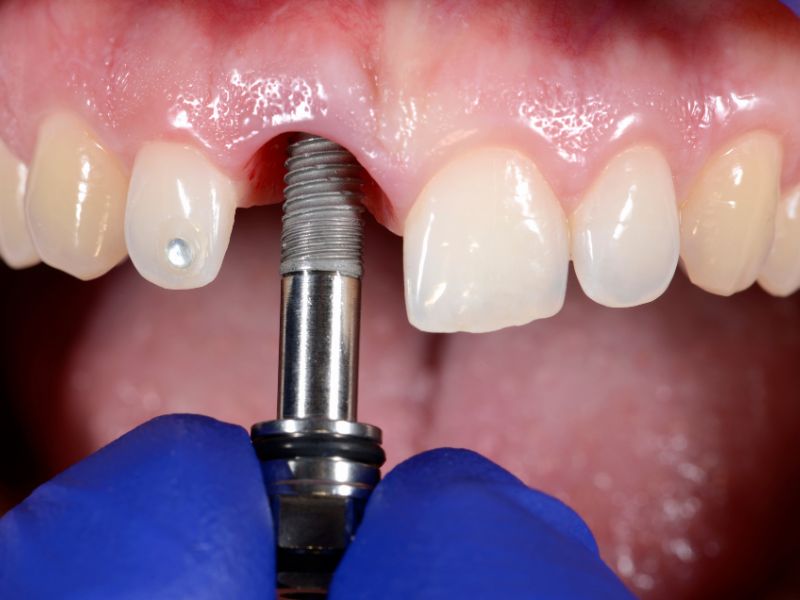 Implantes Dentales Oseointegrados: La Solución Definitiva para Recuperar Tu Sonrisa