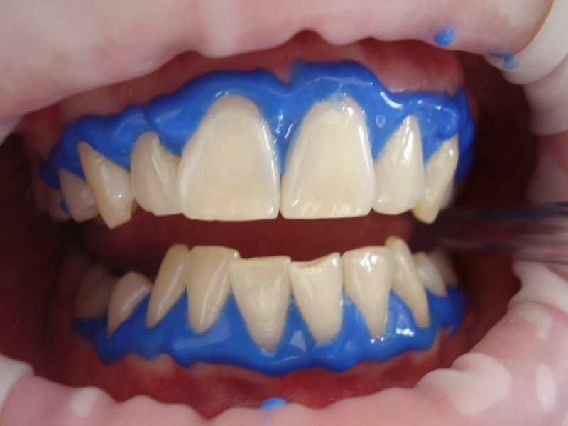 Blanqueamiento dental: Aspectos importantes a considerar previamente.