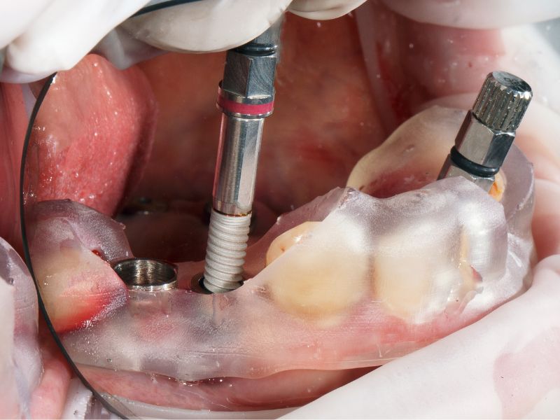 colocación de implantes oseointegrados
